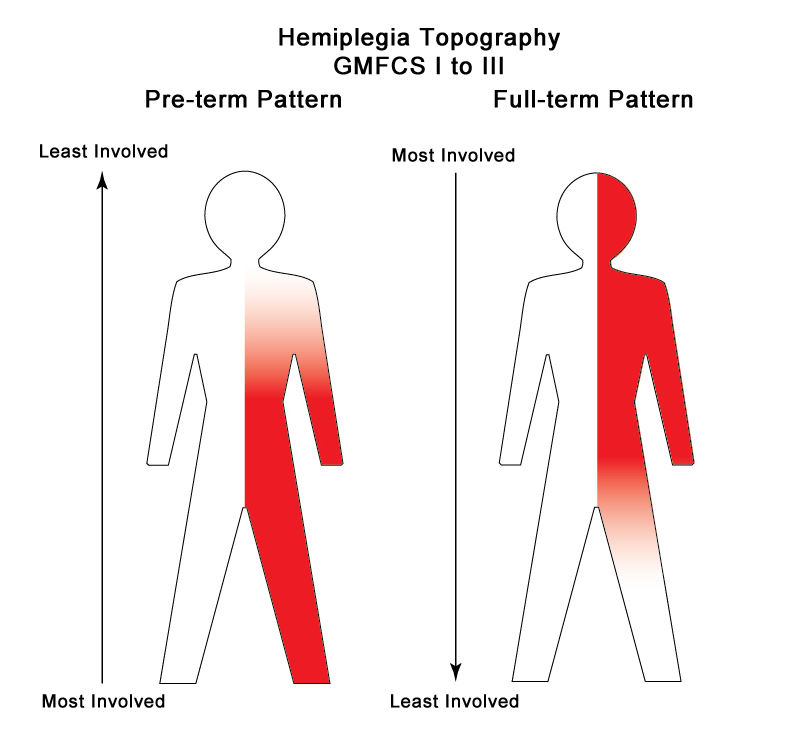 Hemiplegia