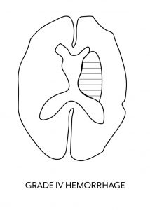 grade-4-hemorrhage